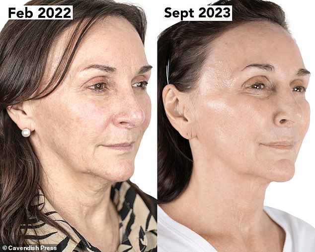 Shirley credited her non-surgical facelift for giving her a glowing complexion after admitting the visible signs of aging had affected her confidence and left her feeling depressed